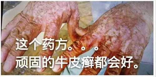 【治皮膚奇癢很有效的土方】